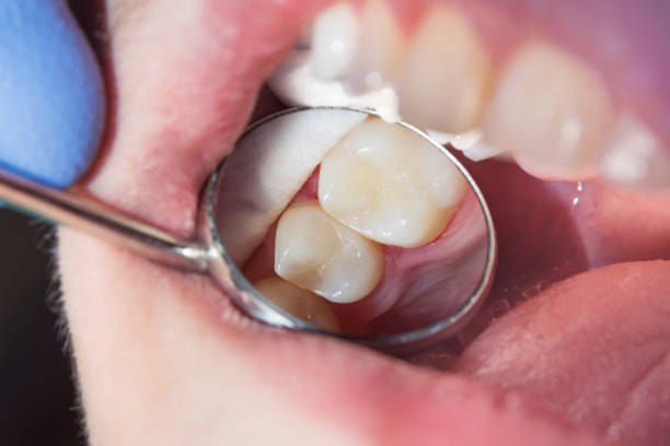 Composite Fillings