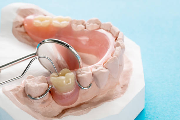 Close up, Artificial removable partial denture