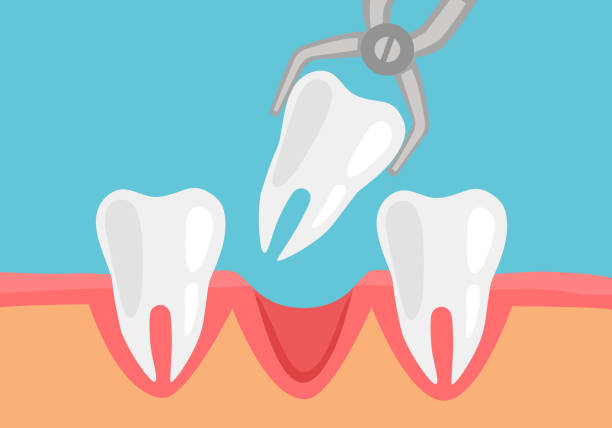 Unhealthy tooth removal process concept vector