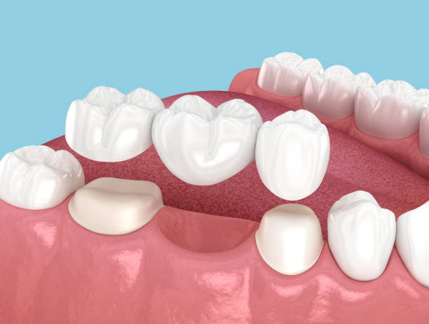 Dental bridge based on 2 teeth. 3D illustration