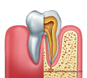SPD Root Canals