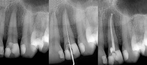 SPD Root Canals