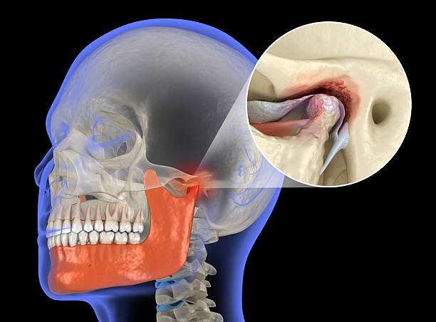 Temporomandibular joints arthritis and dislocated articular disc