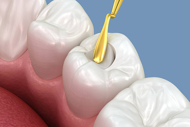 Tooth restoration with filling. Tooth 3D illustration.