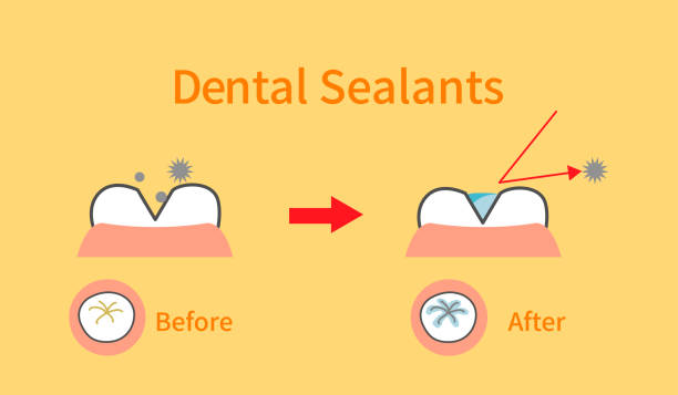 illustrations of dental sealants treatment before after